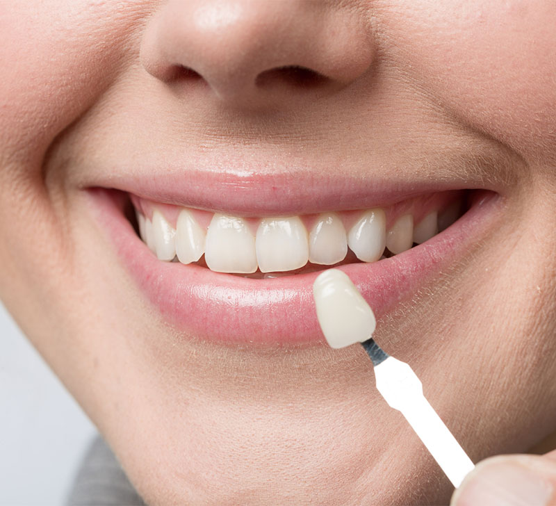 Patient with veneers